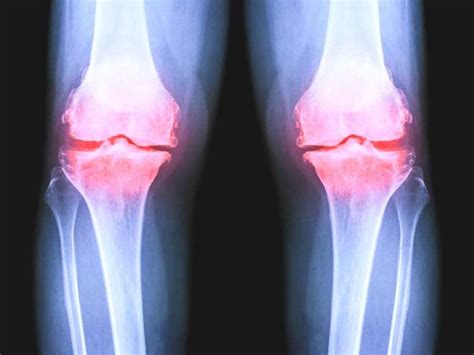 X-Ray for Osteoarthritis of the Knee