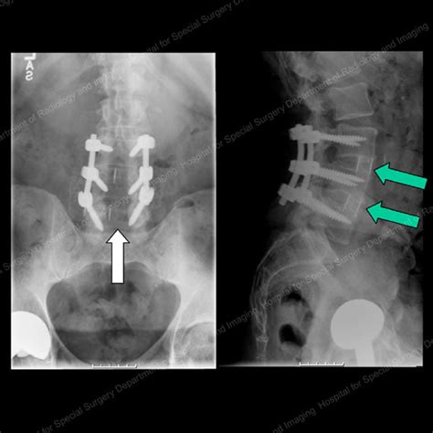 Degenerative Scoliosis: Sideways Spinal Curve in Adults