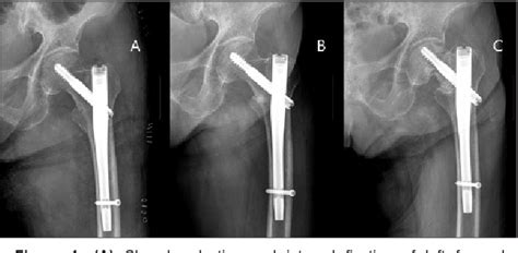 Femoral neck vs intertrochanteric fracture - Julirider