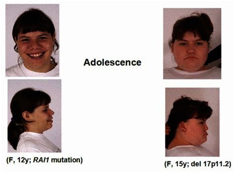 Smith-Magenis syndrome: MedlinePlus Genetics