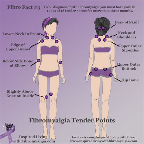 Fibro Fact Series -Fact #3: A Diagnosis of Fibromyalgia includes Pain in Tender Points ...