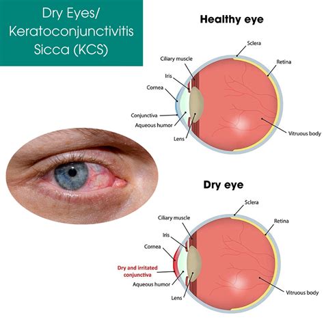 Keratoconjunctivitis Sicca Treatment Downtown Manhattan | My Eye Physicians