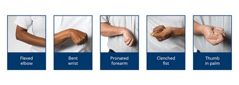 Flexion And Upper Limb Spasticity Stroke