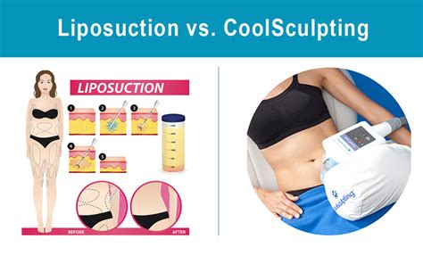 Liposuction vs. CoolSculpting: What Is The Difference & Which is Better?