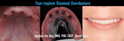 Implant Supported Overdenture | Bucks Dental Health and Esthetics Lansdale,PA