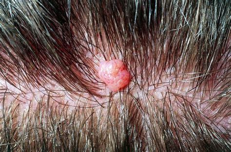 Close-up Of A Benign Mole On Scalp Of Young Man Photograph by Dr P. Marazzi/science Photo Library