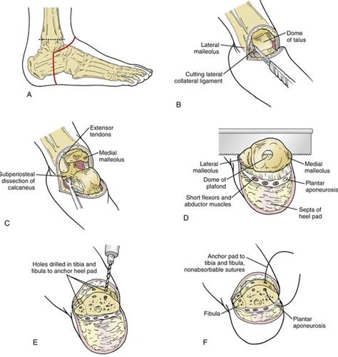 Amputation causes, types of amputation and amputation complications