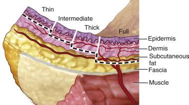 Split Thickness Skin Graft