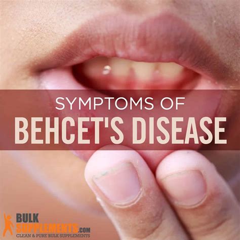 Behcet's Disease: Symptoms, Causes & Treatment