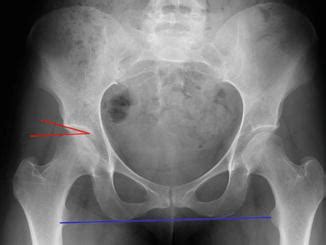 Acetabular Retroversion | Musculoskeletal Key