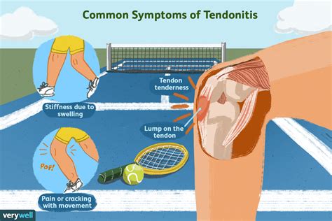 Tendonitis and Tendonopathy: PT Can Help