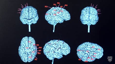 Epilepsy and seizure disorder awareness - Mayo Clinic News Network