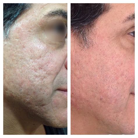 eDermaStamp® by Dermaroller® | Dermaroller® Micro-Needling | Collagen Induction Therapy