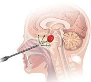 The Best Cushing’s Disease Surgery and Treatment