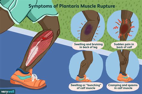 Plantaris Muscle Tears and Calf Pain