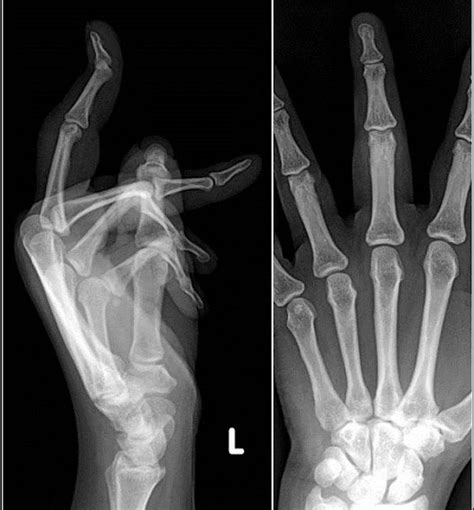 Avulsion Fracture Finger - Fracture Treatment