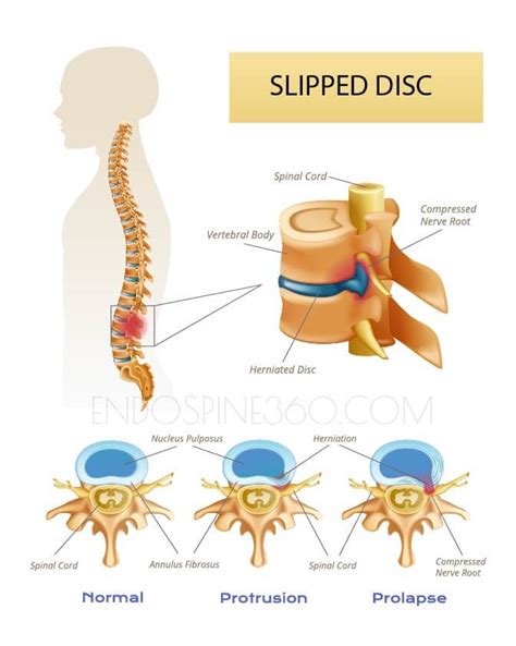 Slipped Disc Doctor | Causes | Diagnosis | Treatment