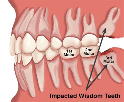 Wisdom teeth