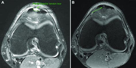 A) MRI of partial patellar tendon rupture before PRP treatment B) MRI... | Download Scientific ...