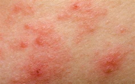 Skin Rash: Symptoms, Causes & Emergency Room Treatment