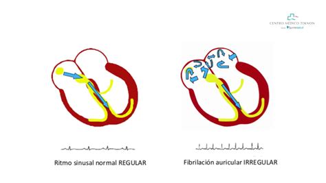 Fibrilación auricular: la arritmia cardiaca más frecuente y la que puede tener peores ...