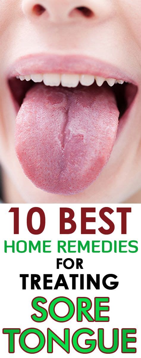 The 25+ best Sore tongue ideas on Pinterest | Sore tongue remedies, Mouth ulcer under tongue and ...