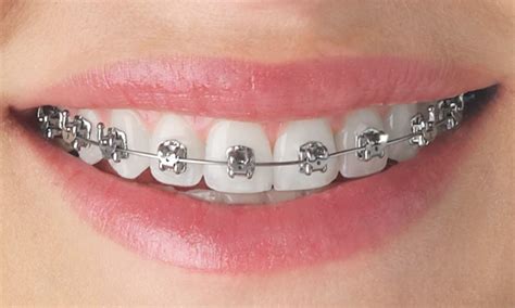 Orthodontic Treatment | Southern Smiles Orthodontics