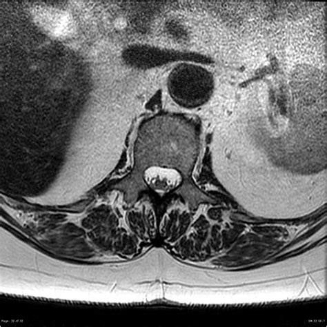 Arachnoiditis | Radiology Case | Radiopaedia.org