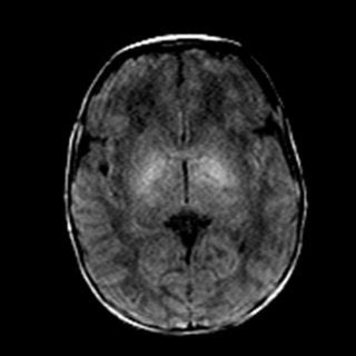 Wernicke Encephalopathy: MRI in a sixteen weeks pregnant woman with ...