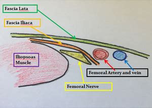 Nerve Block: Femoral - WikEM