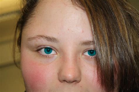 Rarest Eye Color In Humans | Rare Eye Color http://hawaiidermatology.com/rare/rare-eye-color ...