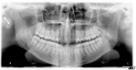 Maxillary Sinuses – Dr. G's Toothpix