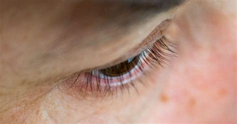 Mucopurulent Conjunctivitis: Causes, Symptoms and Treatment