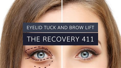 Eyelid Tuck and Brow Lift: The Recovery 411 | Jason Martin M.D.