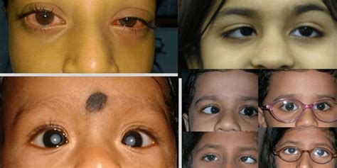 Symptoms that show your child needs a paediatric ophthalmologist