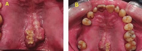 (A) Palatal torus with white lesion from the mirror photographic. (B)... | Download Scientific ...