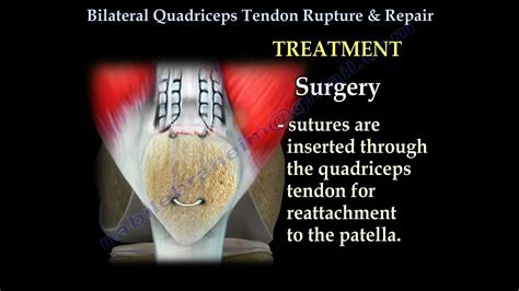 Bilateral Quadriceps Tendon Rupture & Repair Everything You Need To Know Dr Nabil Ebraheim - YouTube