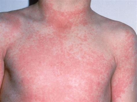 Visual guide to children's rashes and skin conditions | BabyCenter ...