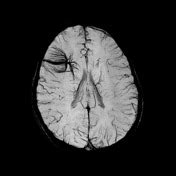 Caput medusae sign (developmental venous anomaly) | Radiology Reference Article | Radiopaedia.org