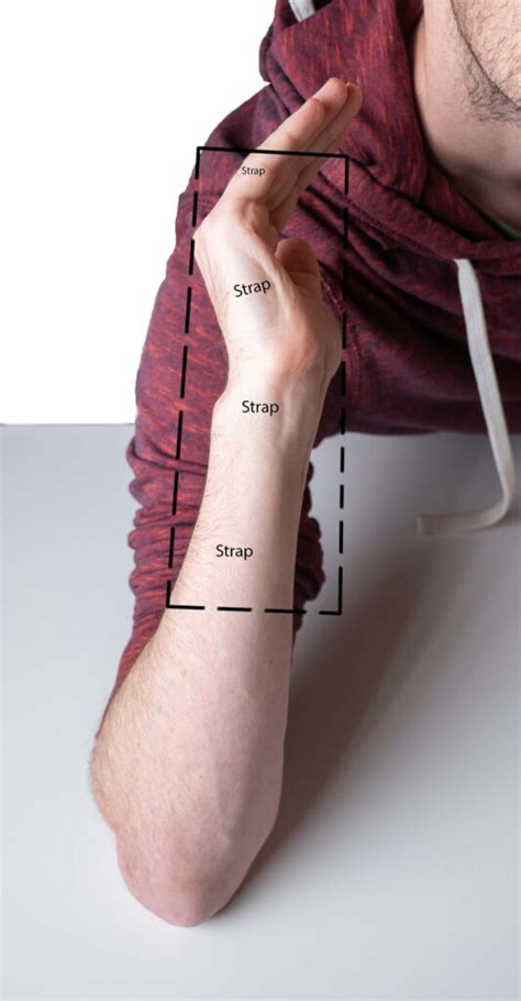 Radial Gutter Splint Pattern