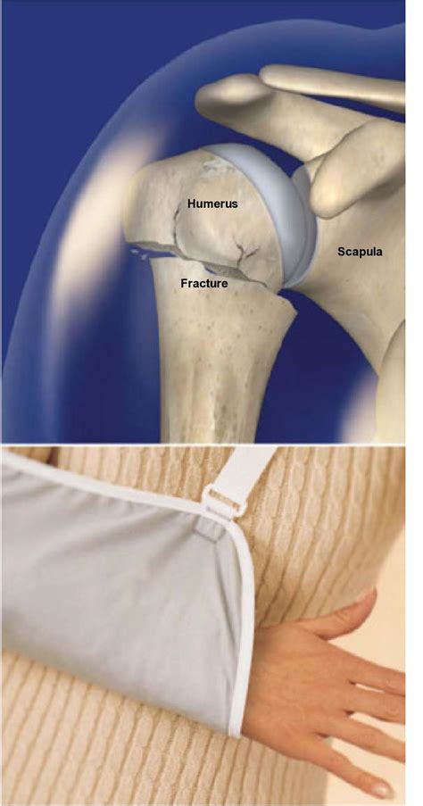 Left Humerus Fracture