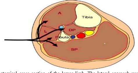 Figure 1 from Comparison of Fasciotomy Wound Closures Using Single against Double incision, and ...