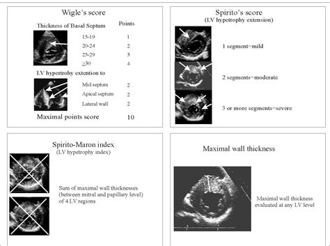 Echocardiography in patients with hypertrophic cardiomyopathy ...