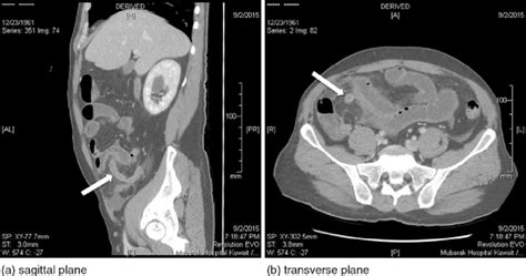 Computed tomography of the abdomen showing the inflamed appendix (white... | Download Scientific ...