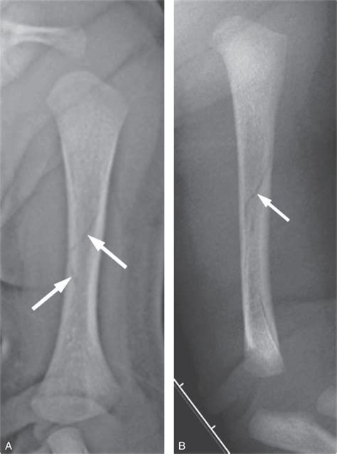 Displaced Spiral Fracture Humerus - HUMERUS FRACTURE | GEORGE D. GOUDELIS MD. Ph.D. / A ...