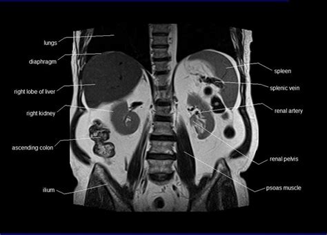 anatomy human abdomen | MRI abdomen coronal anatomy | free cross ...