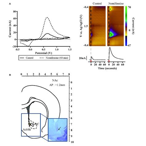 | Effects of fornix deep brain stimulation on glucose metabolism ...