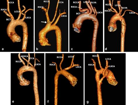 Prevalence and Types of Aortic Arch Variants and Anomalies in ...