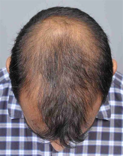 Are There Any Side Effects Of PRP For Hair Restoration?