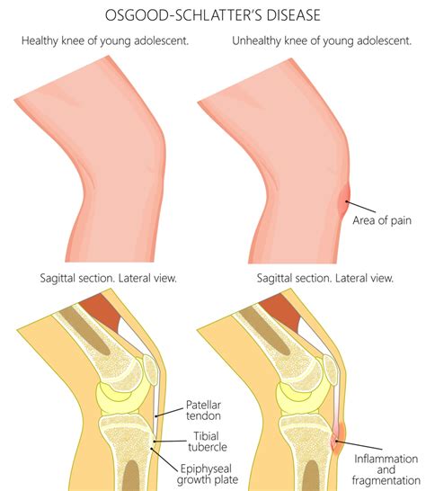 Osgood Schlatters Disease – Dynamic Physio